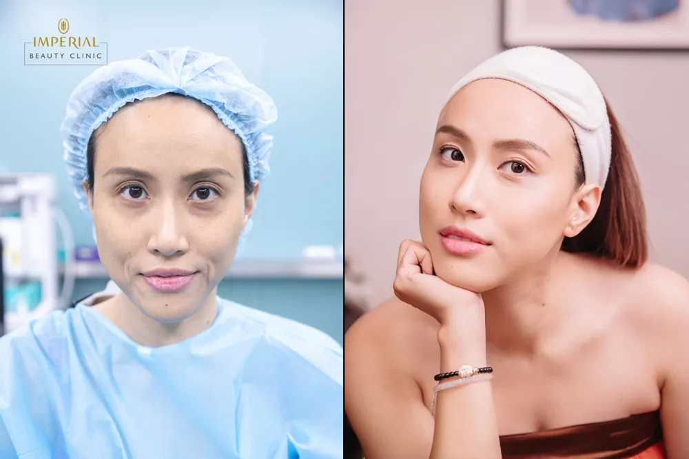 kết quả thực hiện Oligio RF