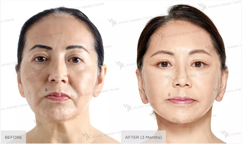 phẫu thuật sắp xếp mỡ mí dưới